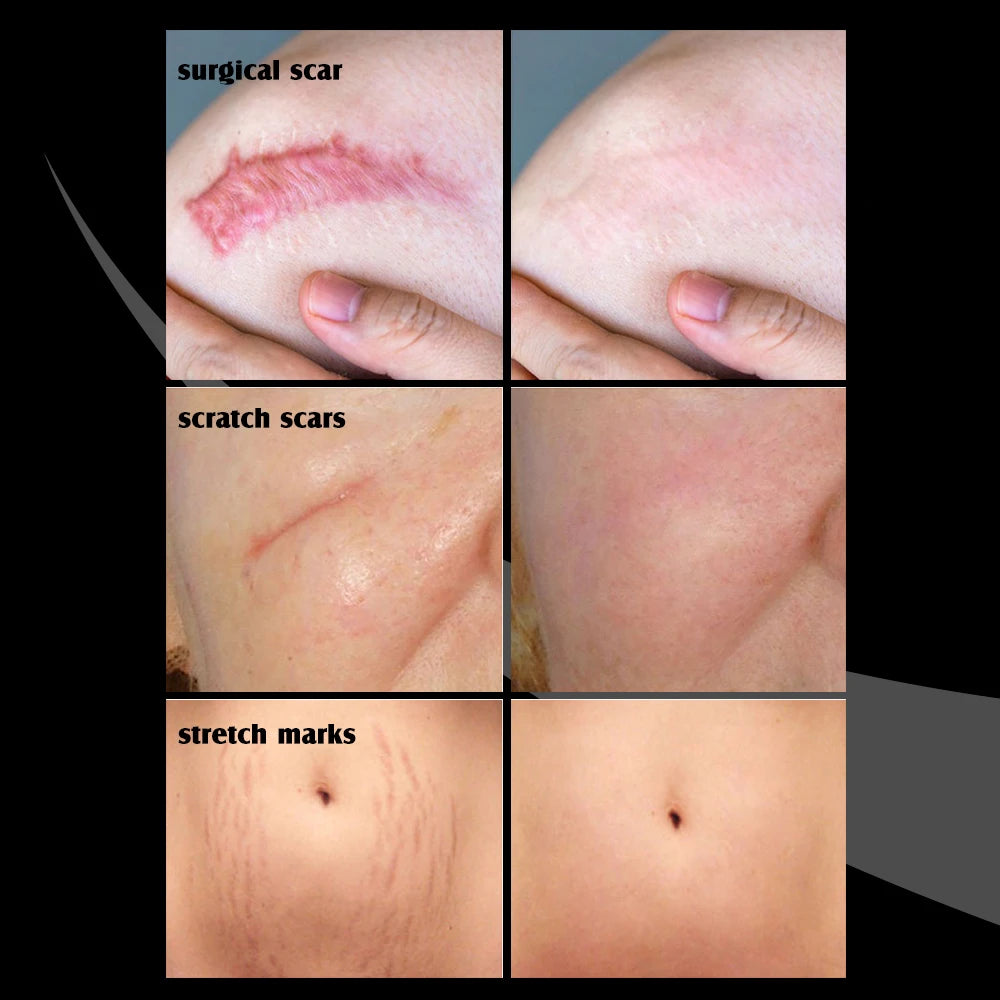 Strong Effective Acne Scar Removal Cream Smoothing Firming New Scars Stretch Marks Pimples Cream