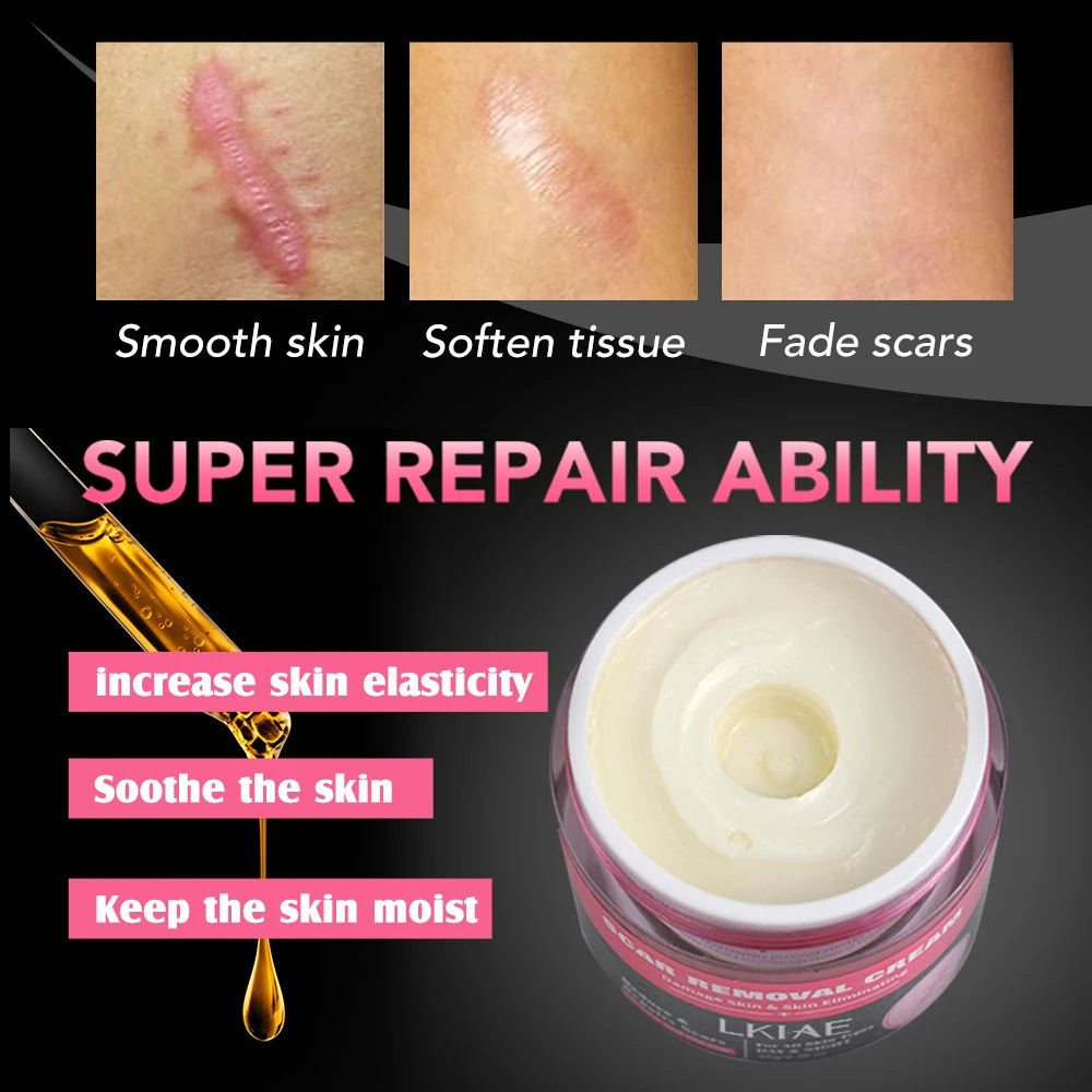 Strong Effective Acne Scar Removal Cream Smoothing Firming New Scars Stretch Marks Pimples Cream