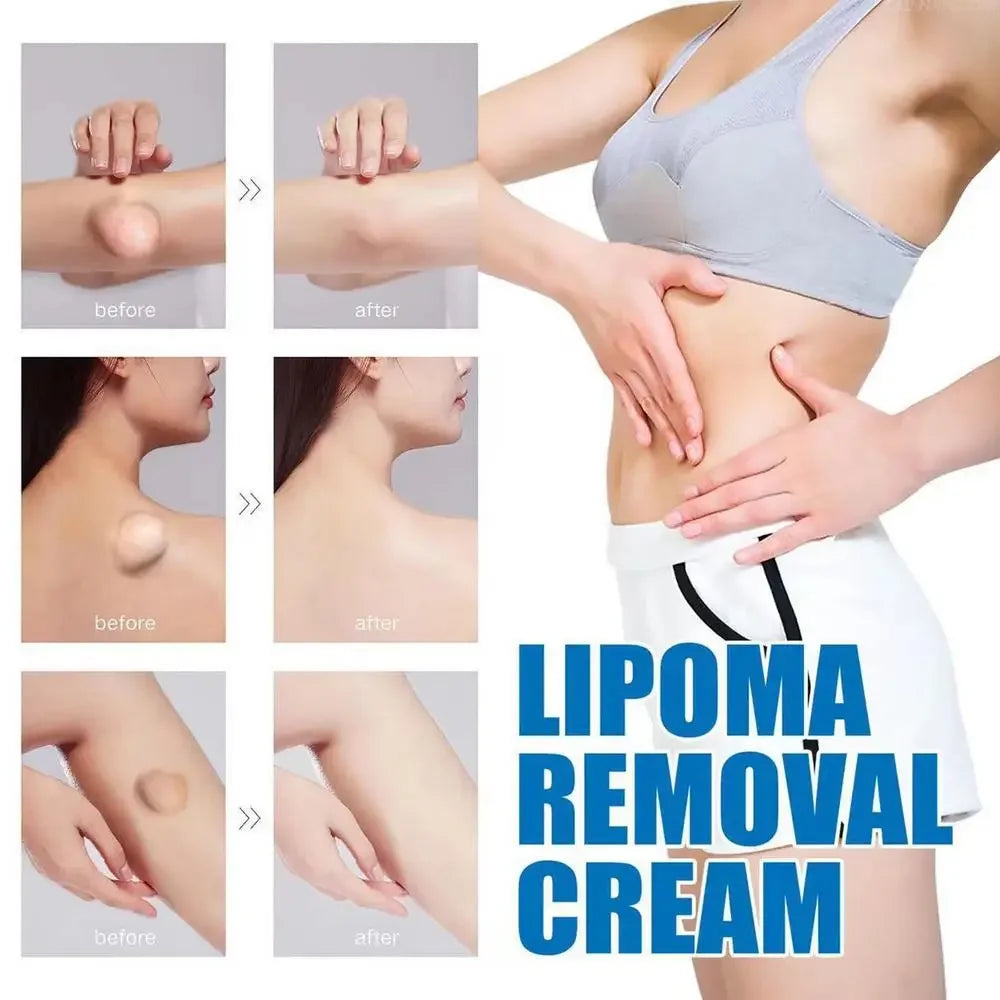 OEM Lipoma Cream 20g Portable Skin Cream Lipoma Care Lotion Multifunctional Lymphatic Ointment