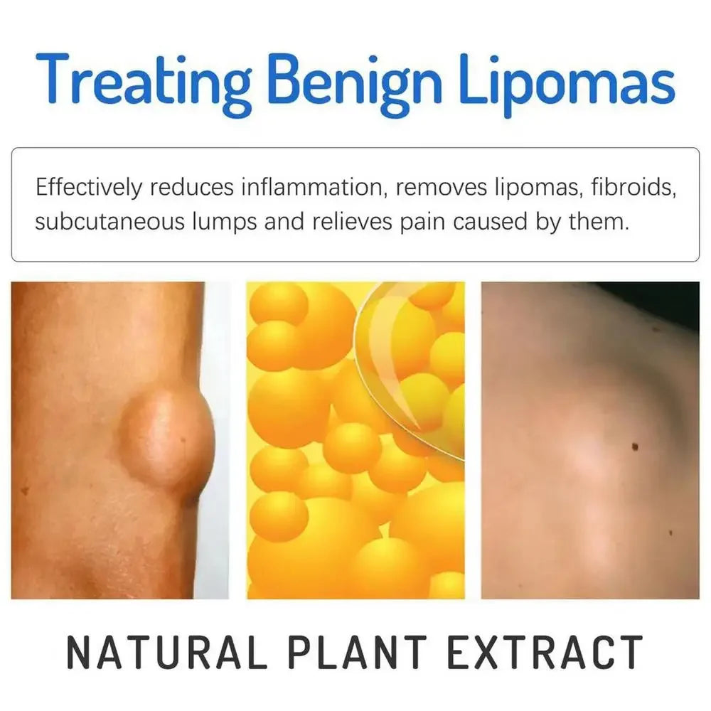OEM Lipoma Cream 20g Portable Skin Cream Lipoma Care Lotion Multifunctional Lymphatic Ointment
