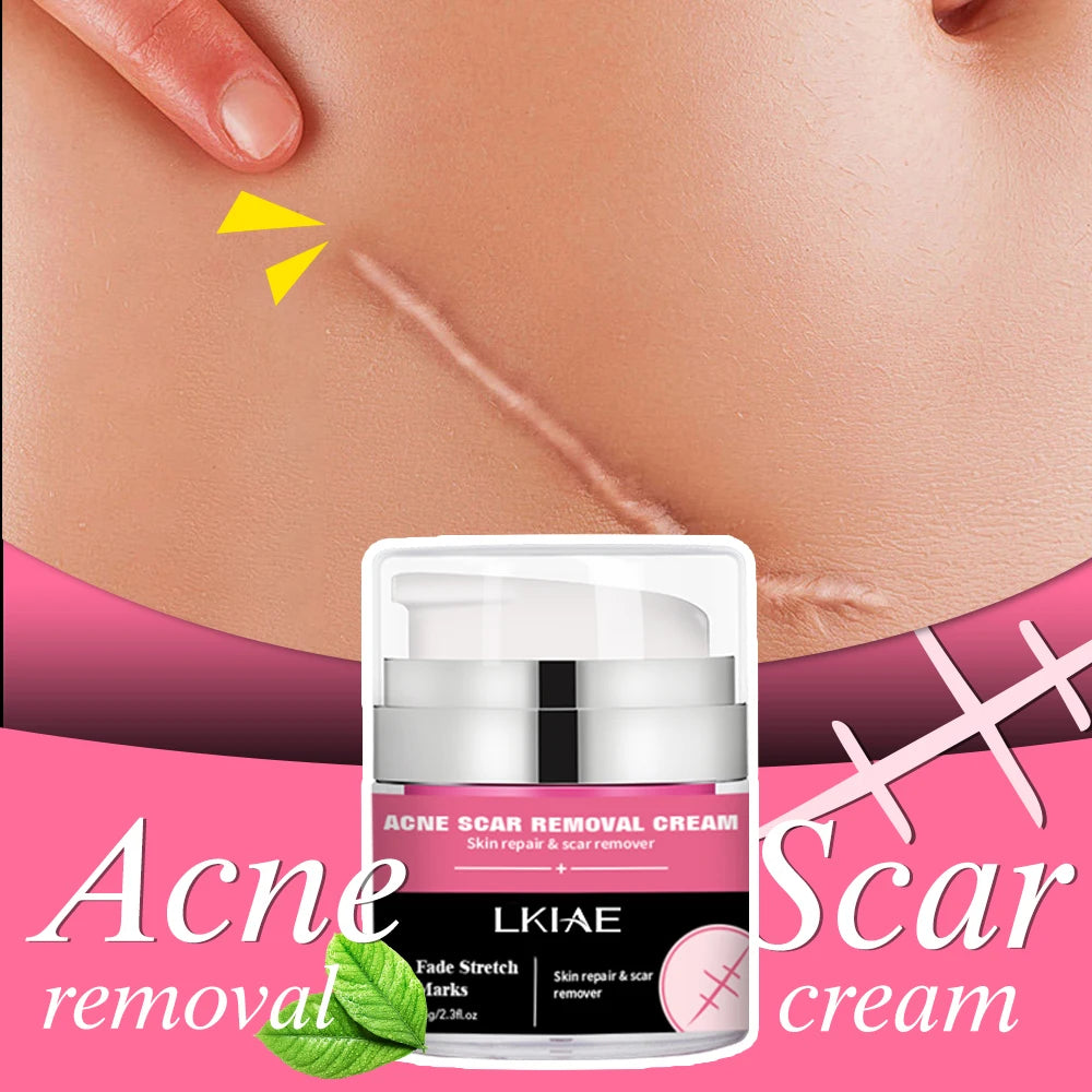 Strong Effective Acne Scar Removal Cream Smoothing Firming New Scars Stretch Marks Pimples Cream