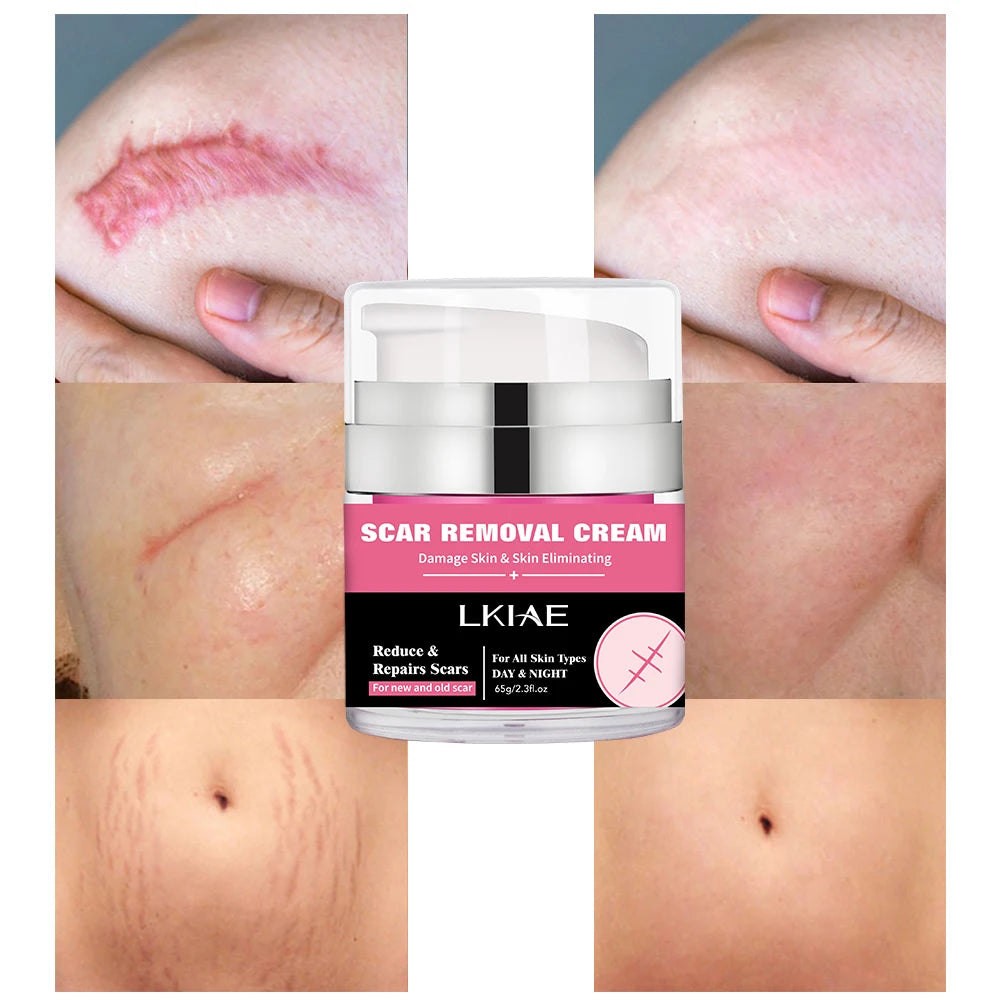 Strong Effective Acne Scar Removal Cream Smoothing Firming New Scars Stretch Marks Pimples Cream